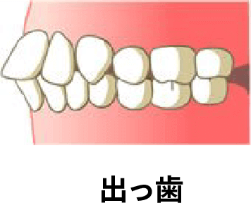 出っ歯