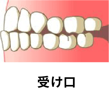 受け口