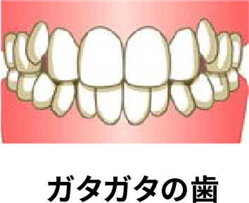 ガタガタの歯