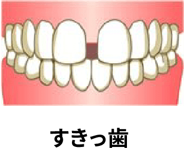 すきっ歯