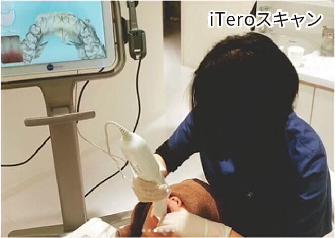 iTeroスキャン