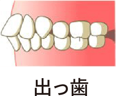 出っ歯
