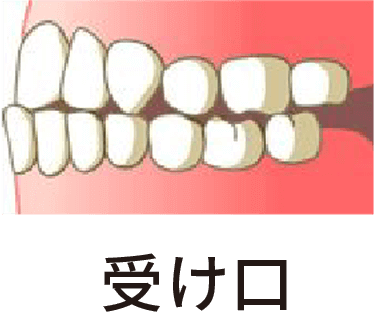 受け口