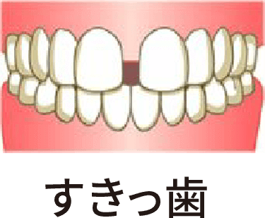 すきっ歯